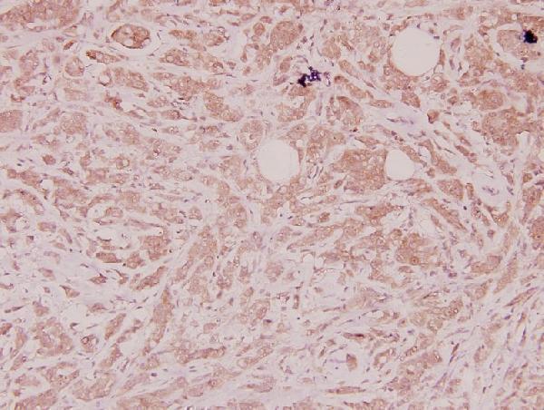 Immunohistochemistry (IHC) analyzes of Defensin α1 (S52) pAb in paraffin-embedded human breast carcinoma tissue at 1:100