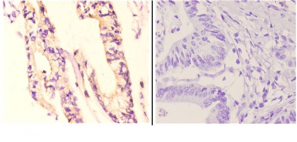 Immunohistochemistry (IHC) analyzes of NDUFA8 (P141) pAb in paraffin-embedded human colon carcinoma tissue at 1:50