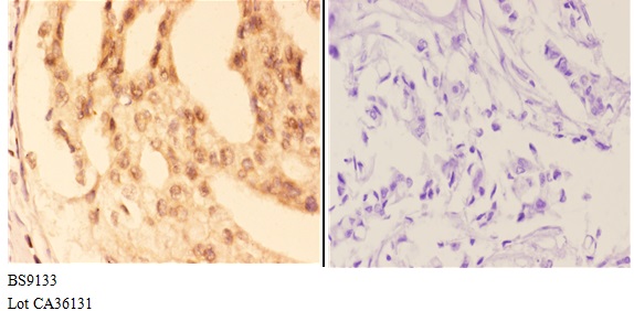 Immunohistochemistry (IHC) analyzes of COL19A1 (Y442) pAb in paraffin-embedded human breast carcinoma tissue at 1:50,showing nucleus staining