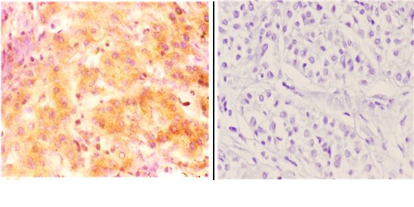 Immunohistochemistry (IHC) analyzes of Inhibin β-C (V129) pAb in paraffin-embedded human liver carcinoma tissue at 1:50