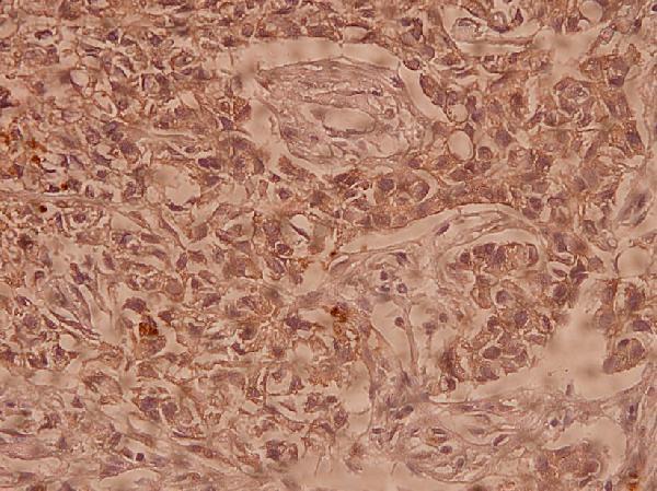 Immunohistochemistry (IHC) analyzes of Claudin-10 (N217) pAb in paraffin-embedded human breast carcinoma tissue at 1:100