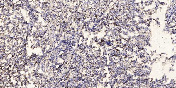 Immunohistochemical analysis of paraffin-embedded human Squamous cell carcinoma of lung