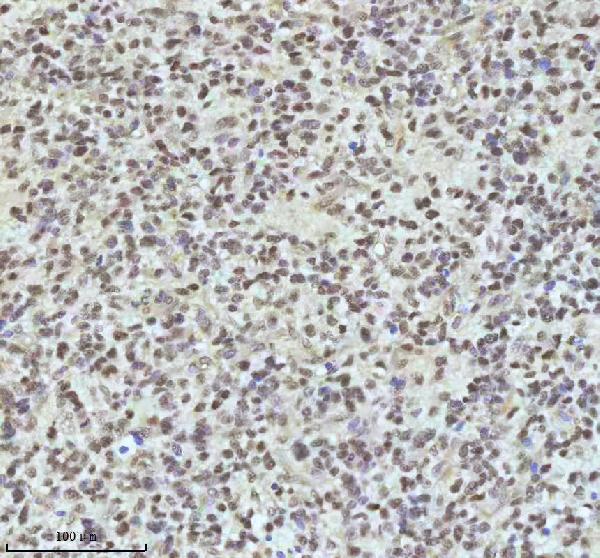 Figure 5. IHC analysis of IRF2BPL using anti-IRF2BPL antibody (A10706). IRF2BPL was detected in a paraffin-embedded section of follicles of human glioma tissue. Heat mediated antigen retrieval was performed in EDTA buffer (pH 8.0, epitope retrieval solution). The tissue section was blocked with 10% goat serum. The tissue section was then incubated with 2 microg/ml rabbit anti-IRF2BPL Antibody (A10706) overnight at 4°C. Peroxidase Conjugated Goat Anti-rabbit IgG was used as secondary antibody and incubated for 30 minutes at 37°C. The tissue section was developed using HRP Conjugated Rabbit IgG Super Vision Assay Kit (Catalog # SV0002) with DAB as the chromogen.