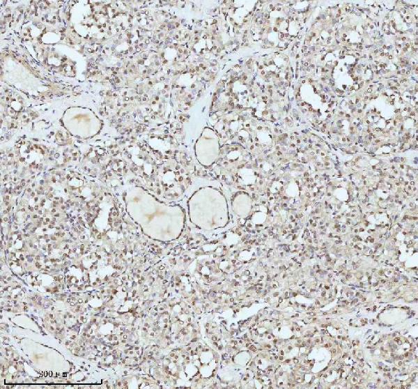 Figure 6. IHC analysis of IRF2BPL using anti-IRF2BPL antibody (A10706). IRF2BPL was detected in a paraffin-embedded section of follicles of human thyroid cancer tissue. Heat mediated antigen retrieval was performed in EDTA buffer (pH 8.0, epitope retrieval solution). The tissue section was blocked with 10% goat serum. The tissue section was then incubated with 2 microg/ml rabbit anti-IRF2BPL Antibody (A10706) overnight at 4°C. Peroxidase Conjugated Goat Anti-rabbit IgG was used as secondary antibody and incubated for 30 minutes at 37°C. The tissue section was developed using HRP Conjugated Rabbit IgG Super Vision Assay Kit (Catalog # SV0002) with DAB as the chromogen.