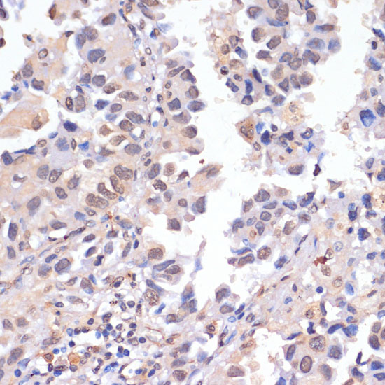 Immunohistochemistry of paraffin-embedded human lung cancer using PIDD antibody  at dilution of 1:100 