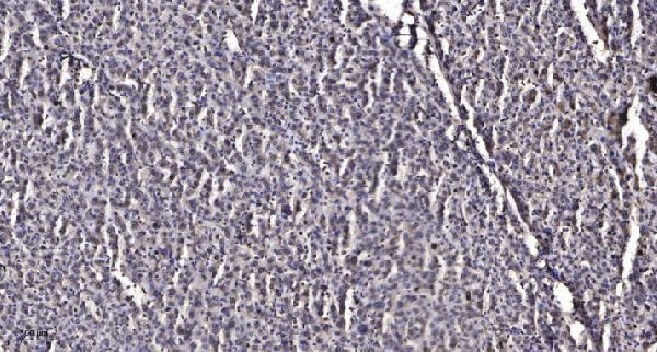 Immunohistochemical analysis of paraffin-embedded human liver cancer