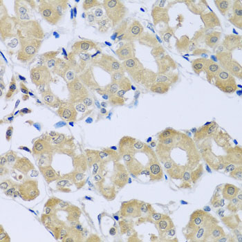 Immunohistochemistry of paraffin-embedded human liver cancer using SYT4 antibody at dilution of 1:100 (x40 lens)