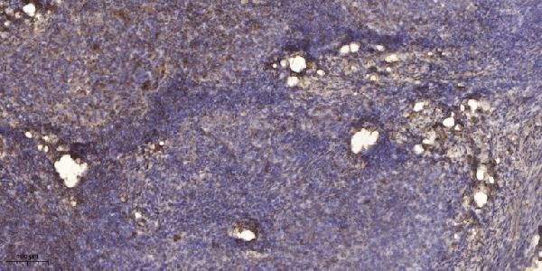 Immunohistochemical analysis of paraffin-embedded human cervical carcinoma