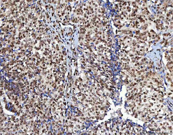 Figure 3. IHC analysis of NUDCD1 using anti-NUDCD1 antibody (A10778-1). NUDCD1 was detected in a paraffin-embedded section of human ovarian cancer tissue. Heat mediated antigen retrieval was performed in EDTA buffer (pH 8.0, epitope retrieval solution). The tissue section was blocked with 10% goat serum. The tissue section was then incubated with 2 microg/ml rabbit anti-NUDCD1 Antibody (A10778-1) overnight at 4°C. Peroxidase Conjugated Goat Anti-rabbit IgG was used as secondary antibody and incubated for 30 minutes at 37°C. The tissue section was developed using HRP Conjugated Rabbit IgG Super Vision Assay Kit (Catalog # SV0002) with DAB as the chromogen. Figure 3. IHC analysis of NUDCD1 using anti-NUDCD1 antibody (A10778-1). NUDCD1 was detected in a paraffin-embedded section of human ovarian cancer tissue. Heat mediated antigen retrieval was performed in EDTA buffer (pH 8.0, epitope retrieval solution). The tissue section was blocked with 10% goat serum. The tissue section was then incubated with 2 microg/ml rabbit anti-NUDCD1 Antibody (A10778-1) overnight at 4°C. Peroxidase Conjugated Goat Anti-rabbit IgG was used as secondary antibody and incubated for 30 minutes at 37°C. The tissue section was developed using HRP Conjugated Rabbit IgG Super Vision Assay Kit (Catalog # SV0002) with DAB as the chromogen.