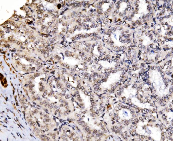 Figure 2. IHC analysis of RAX2 using anti-RAX2 antibody (A10782-1). RAX2 was detected in a paraffin-embedded section of human hashimoto thyroiditis tissue. Heat mediated antigen retrieval was performed in EDTA buffer (pH 8.0, epitope retrieval solution). The tissue section was blocked with 10% goat serum. The tissue section was then incubated with 2 microg/ml rabbit anti-RAX2 Antibody (A10782-1) overnight at 4°C. Biotinylated goat anti-rabbit IgG was used as secondary antibody and incubated for 30 minutes at 37°C. The tissue section was developed using Strepavidin-Biotin-Complex (SABC) (Catalog # SA1022) with DAB as the chromogen.