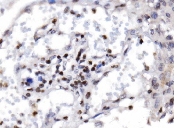 Figure 3. IHC analysis of RAX2 using anti-RAX2 antibody (A10782-1). RAX2 was detected in a paraffin-embedded section of human laryngeal squamous cell carcinoma tissue. Heat mediated antigen retrieval was performed in EDTA buffer (pH 8.0, epitope retrieval solution). The tissue section was blocked with 10% goat serum. The tissue section was then incubated with 2 microg/ml rabbit anti-RAX2 Antibody (A10782-1) overnight at 4°C. Biotinylated goat anti-rabbit IgG was used as secondary antibody and incubated for 30 minutes at 37°C. The tissue section was developed using Strepavidin-Biotin-Complex (SABC) (Catalog # SA1022) with DAB as the chromogen.
