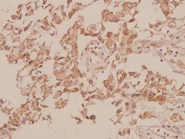 Immunohistochemistry (IHC) analyzes of M-cadherin (A108) pAb in paraffin-embedded human breast carcinoma tissue at 1:50