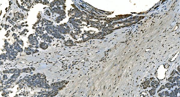 Figure 4. IHC analysis of LSM8 using anti-LSM8 antibody (A10947). LSM8 was detected in paraffin-embedded section of human ovary cancer tissue. Heat mediated antigen retrieval was performed in EDTA buffer (pH8.0, epitope retrieval solution). The tissue section was blocked with 10% goat serum. The tissue section was then incubated with 2microg/ml rabbit anti-LSM8 Antibody (A10947) overnight at 4°C. Biotinylated goat anti-rabbit IgG was used as secondary antibody and incubated for 30 minutes at 37°C. The tissue section was developed using Strepavidin-Biotin-Complex (SABC) (Catalog # SA1022) with DAB as the chromogen. Figure 4. IHC analysis of LSM8 using anti-LSM8 antibody (A10947). LSM8 was detected in paraffin-embedded section of human ovary cancer tissue. Heat mediated antigen retrieval was performed in EDTA buffer (pH8.0, epitope retrieval solution). The tissue section was blocked with 10% goat serum. The tissue section was then incubated with 2microg/ml rabbit anti-LSM8 Antibody (A10947) overnight at 4°C. Biotinylated goat anti-rabbit IgG was used as secondary antibody and incubated for 30 minutes at 37°C. The tissue section was developed using Strepavidin-Biotin-Complex (SABC) (Catalog # SA1022) with DAB as the chromogen.