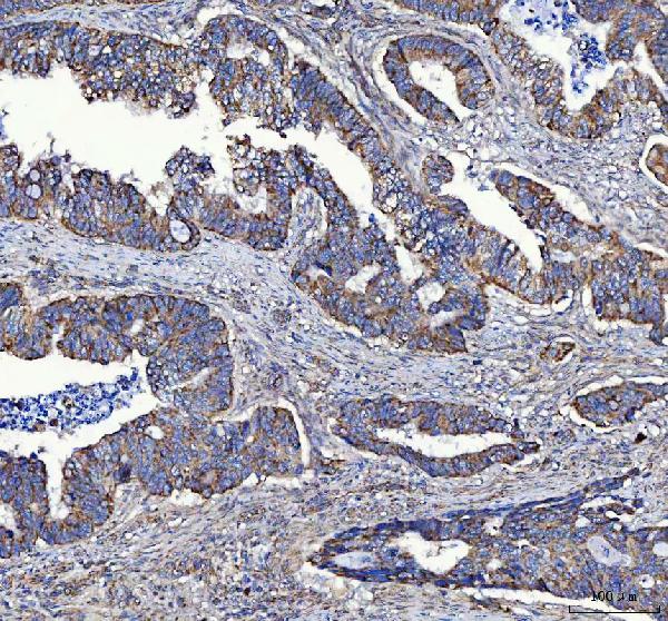 Figure 2. IHC analysis of MTCL1 using anti-MTCL1 antibody (A10954-1). MTCL1 was detected in a paraffin-embedded section of human colorectal adenocarcinoma tissue. Heat mediated antigen retrieval was performed in EDTA buffer (pH 8.0, epitope retrieval solution). The tissue section was blocked with 10% goat serum. The tissue section was then incubated with 2 microg/ml rabbit anti-MTCL1 Antibody (A10954-1) overnight at 4°C. Peroxidase Conjugated Goat Anti-rabbit IgG was used as secondary antibody and incubated for 30 minutes at 37°C. The tissue section was developed using HRP Conjugated Rabbit IgG Super Vision Assay Kit (Catalog # SV0002) with DAB as the chromogen.