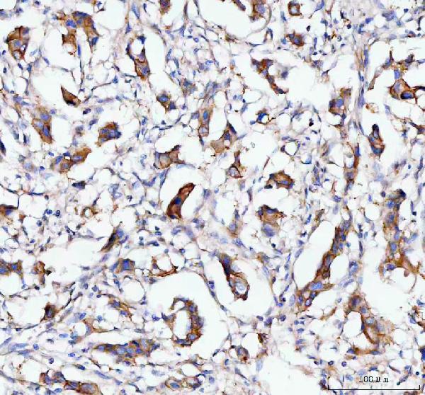 Figure 3. IHC analysis of MOGAT2 using anti-MOGAT2 antibody (A10993-2). MOGAT2 was detected in a paraffin-embedded section of human breast cancer tissue. Heat mediated antigen retrieval was performed in EDTA buffer (pH 8.0, epitope retrieval solution). The tissue section was blocked with 10% goat serum. The tissue section was then incubated with 2 microg/ml rabbit anti-MOGAT2 Antibody (A10993-2) overnight at 4°C. Peroxidase Conjugated Goat Anti-rabbit IgG was used as secondary antibody and incubated for 30 minutes at 37°C. The tissue section was developed using HRP Conjugated Rabbit IgG Super Vision Assay Kit (Catalog # SV0002) with DAB as the chromogen. Figure 3. IHC analysis of MOGAT2 using anti-MOGAT2 antibody (A10993-2). MOGAT2 was detected in a paraffin-embedded section of human breast cancer tissue. Heat mediated antigen retrieval was performed in EDTA buffer (pH 8.0, epitope retrieval solution). The tissue section was blocked with 10% goat serum. The tissue section was then incubated with 2 microg/ml rabbit anti-MOGAT2 Antibody (A10993-2) overnight at 4°C. Peroxidase Conjugated Goat Anti-rabbit IgG was used as secondary antibody and incubated for 30 minutes at 37°C. The tissue section was developed using HRP Conjugated Rabbit IgG Super Vision Assay Kit (Catalog # SV0002) with DAB as the chromogen.