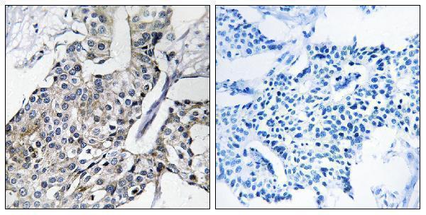Immunohistochemistry analysis of paraffin-embedded human breast carcinoma, using GBP4 Antibody