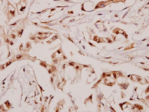 Immunohistochemistry (IHC) analyzes of Angptl7 (P346) pAb in paraffin-embedded human breast carcinoma tissue at 1:50