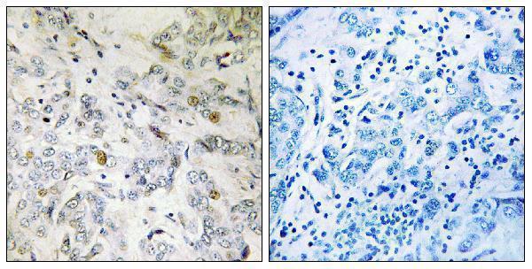 Immunohistochemistry analysis of paraffin-embedded human breast carcinoma tissue, using HCC1 Antibody