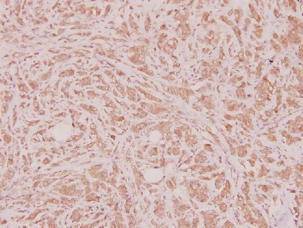 Immunohistochemistry (IHC) analyzes of HoxD12 (E230) pAb in paraffin-embedded human breast carcinoma tissue at 1:100