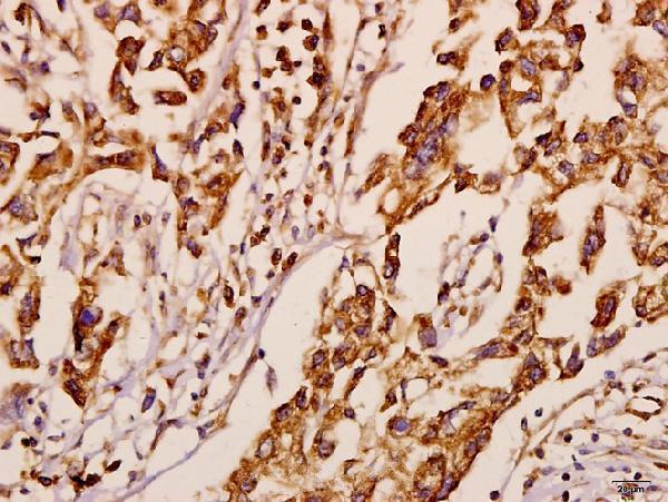 Immunohistochemistry (IHC) analyzes of Neuralized-1 (V250) pAb in paraffin-embedded human breast carcinoma tissue at 1:50