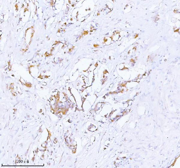 Figure 2. IHC analysis of PCYOX1 using anti-PCYOX1 antibody (A11180-1). PCYOX1 was detected in a paraffin-embedded section of human breast cancer tissue. Heat mediated antigen retrieval was performed in EDTA buffer (pH 8.0, epitope retrieval solution). The tissue section was blocked with 10% goat serum. The tissue section was then incubated with 2 microg/ml rabbit anti-PCYOX1 Antibody (A11180-1) overnight at 4°C. Peroxidase Conjugated Goat Anti-rabbit IgG was used as secondary antibody and incubated for 30 minutes at 37°C. The tissue section was developed using HRP Conjugated Rabbit IgG Super Vision Assay Kit (Catalog # SV0002) with DAB as the chromogen. Figure 2. IHC analysis of PCYOX1 using anti-PCYOX1 antibody (A11180-1). PCYOX1 was detected in a paraffin-embedded section of human breast cancer tissue. Heat mediated antigen retrieval was performed in EDTA buffer (pH 8.0, epitope retrieval solution). The tissue section was blocked with 10% goat serum. The tissue section was then incubated with 2 microg/ml rabbit anti-PCYOX1 Antibody (A11180-1) overnight at 4°C. Peroxidase Conjugated Goat Anti-rabbit IgG was used as secondary antibody and incubated for 30 minutes at 37°C. The tissue section was developed using HRP Conjugated Rabbit IgG Super Vision Assay Kit (Catalog # SV0002) with DAB as the chromogen.