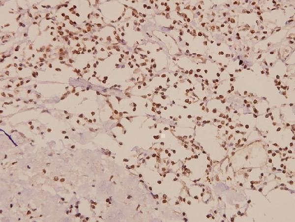 Immunohistochemistry (IHC) analyzes of TAF I p48 (R318) pAb in paraffin-embedded human breast carcinoma tissue at 1:50