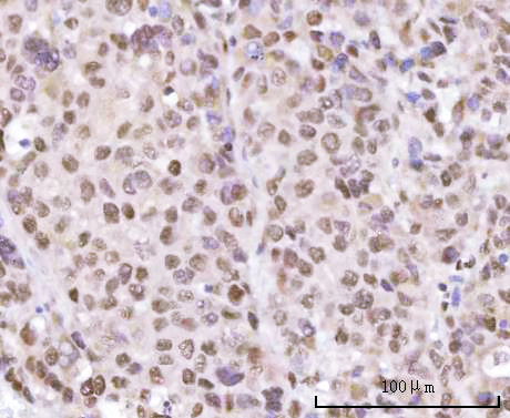 Figure 2. IHC analysis of SF3A2 using anti-SF3A2 antibody (A11289-2). SF3A2 was detected in a paraffin-embedded section of human liver cancer tissue. Heat mediated antigen retrieval was performed in EDTA buffer (pH 8.0, epitope retrieval solution). The tissue section was blocked with 10% goat serum. The tissue section was then incubated with 2 microg/ml rabbit anti-SF3A2 Antibody (A11289-2) overnight at 4°C. Peroxidase Conjugated Goat Anti-rabbit IgG was used as secondary antibody and incubated for 30 minutes at 37°C. The tissue section was developed using HRP Conjugated Rabbit IgG Super Vision Assay Kit (Catalog # SV0002) with DAB as the chromogen.