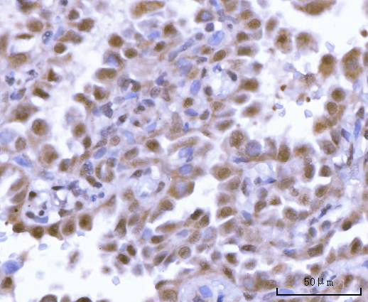 Figure 3. IHC analysis of SF3A2 using anti-SF3A2 antibody (A11289-2). SF3A2 was detected in a paraffin-embedded section of human lung adenocarcinoma tissue. Heat mediated antigen retrieval was performed in EDTA buffer (pH 8.0, epitope retrieval solution). The tissue section was blocked with 10% goat serum. The tissue section was then incubated with 2 microg/ml rabbit anti-SF3A2 Antibody (A11289-2) overnight at 4°C. Peroxidase Conjugated Goat Anti-rabbit IgG was used as secondary antibody and incubated for 30 minutes at 37°C. The tissue section was developed using HRP Conjugated Rabbit IgG Super Vision Assay Kit (Catalog # SV0002) with DAB as the chromogen.