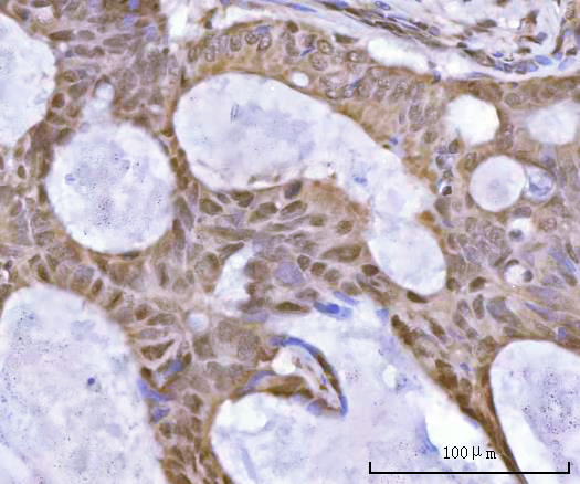 Figure 5. IHC analysis of SF3A2 using anti-SF3A2 antibody (A11289-2). SF3A2 was detected in a paraffin-embedded section of human rectum adenocarcinoma tissue. Heat mediated antigen retrieval was performed in EDTA buffer (pH 8.0, epitope retrieval solution). The tissue section was blocked with 10% goat serum. The tissue section was then incubated with 2 microg/ml rabbit anti-SF3A2 Antibody (A11289-2) overnight at 4°C. Peroxidase Conjugated Goat Anti-rabbit IgG was used as secondary antibody and incubated for 30 minutes at 37°C. The tissue section was developed using HRP Conjugated Rabbit IgG Super Vision Assay Kit (Catalog # SV0002) with DAB as the chromogen.