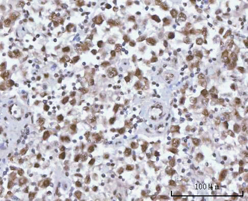 Figure 6. IHC analysis of SF3A2 using anti-SF3A2 antibody (A11289-2). SF3A2 was detected in a paraffin-embedded section of human testicular seminoma tissue. Heat mediated antigen retrieval was performed in EDTA buffer (pH 8.0, epitope retrieval solution). The tissue section was blocked with 10% goat serum. The tissue section was then incubated with 2 microg/ml rabbit anti-SF3A2 Antibody (A11289-2) overnight at 4°C. Peroxidase Conjugated Goat Anti-rabbit IgG was used as secondary antibody and incubated for 30 minutes at 37°C. The tissue section was developed using HRP Conjugated Rabbit IgG Super Vision Assay Kit (Catalog # SV0002) with DAB as the chromogen.