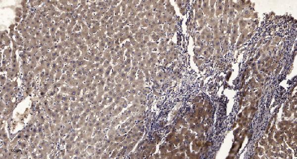 Immunohistochemical analysis of paraffin-embedded human liver cancer