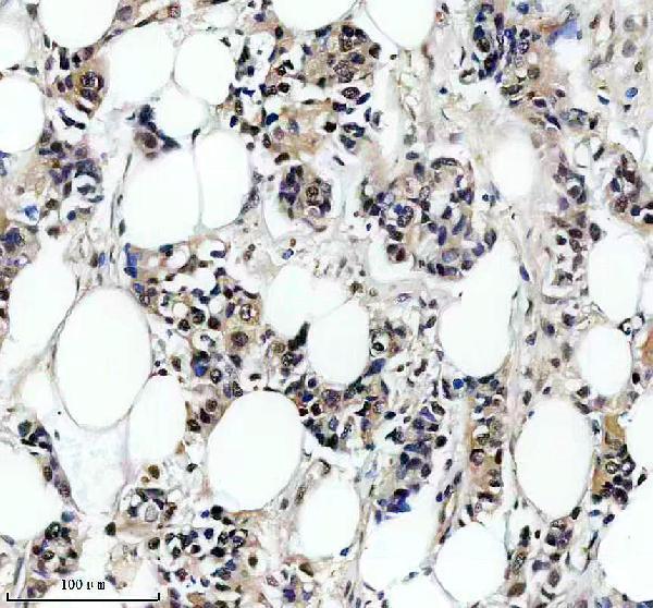 IHC analysis of PSMB3 using anti-PSMB3 antibody (A11330-1)