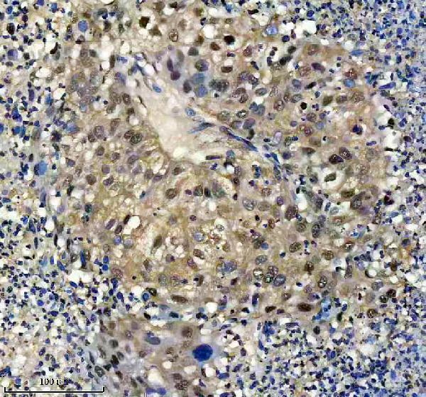 IHC analysis of PSMB3 using anti-PSMB3 antibody (A11330-1)