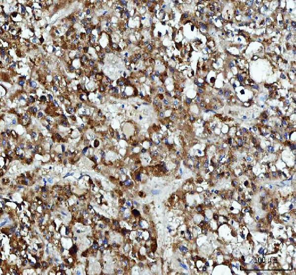 Figure 3. IHC analysis of XTP3TPA/DCTPP1 using anti-XTP3TPA/DCTPP1 antibody (A11334-1). XTP3TPA/DCTPP1 was detected in a paraffin-embedded section of human liver cancer tissue. Heat mediated antigen retrieval was performed in EDTA buffer (pH 8.0, epitope retrieval solution). The tissue section was blocked with 10% goat serum. The tissue section was then incubated with 2 microg/ml rabbit anti-XTP3TPA/DCTPP1 Antibody (A11334-1) overnight at 4°C. Peroxidase Conjugated Goat Anti-rabbit IgG was used as secondary antibody and incubated for 30 minutes at 37°C. The tissue section was developed using HRP Conjugated Rabbit IgG Super Vision Assay Kit (Catalog # SV0002) with DAB as the chromogen.