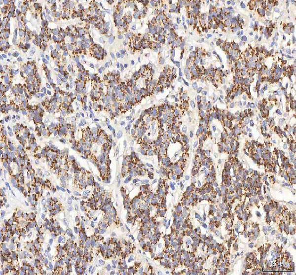 Figure 2. IHC analysis of BPNT2 using anti-BPNT2 antibody (A11341-2). BPNT2 was detected in a paraffin-embedded section of human lung cancer tissue. Heat mediated antigen retrieval was performed in EDTA buffer (pH 8.0, epitope retrieval solution). The tissue section was blocked with 10% goat serum. The tissue section was then incubated with 2 microg/ml rabbit anti-BPNT2 Antibody (A11341-2) overnight at 4°C. Peroxidase Conjugated Goat Anti-rabbit IgG was used as secondary antibody and incubated for 30 minutes at 37°C. The tissue section was developed using HRP Conjugated Rabbit IgG Super Vision Assay Kit (Catalog # SV0002) with DAB as the chromogen.