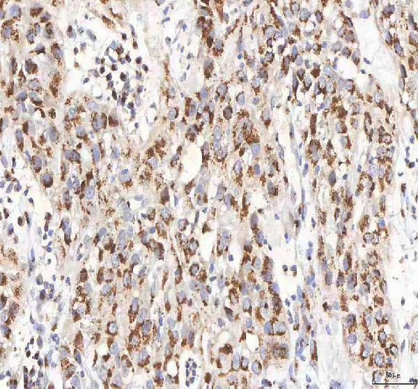 Figure 8. IHC analysis of BPNT2 using anti-BPNT2 antibody (A11341-2). BPNT2 was detected in a paraffin-embedded section of human urothelial carcinoma tissue. Heat mediated antigen retrieval was performed in EDTA buffer (pH 8.0, epitope retrieval solution). The tissue section was blocked with 10% goat serum. The tissue section was then incubated with 2 microg/ml rabbit anti-BPNT2 Antibody (A11341-2) overnight at 4°C. Peroxidase Conjugated Goat Anti-rabbit IgG was used as secondary antibody and incubated for 30 minutes at 37°C. The tissue section was developed using HRP Conjugated Rabbit IgG Super Vision Assay Kit (Catalog # SV0002) with DAB as the chromogen.