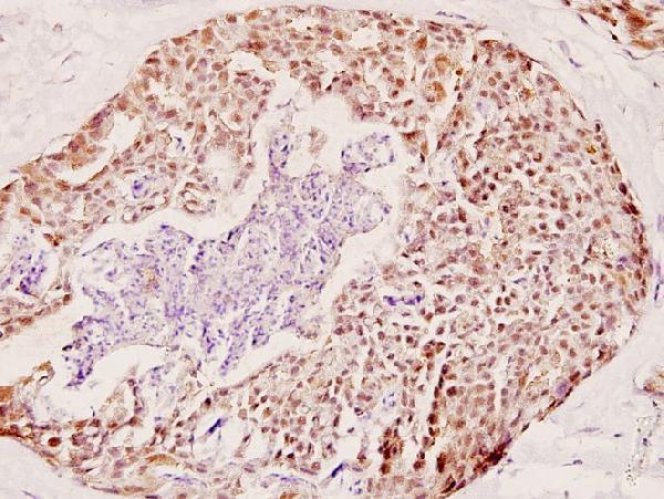 Immunohistochemistry (IHC) analyzes of COX6c (R40) pAb in paraffin-embedded human breast carcinoma tissue at 1:100