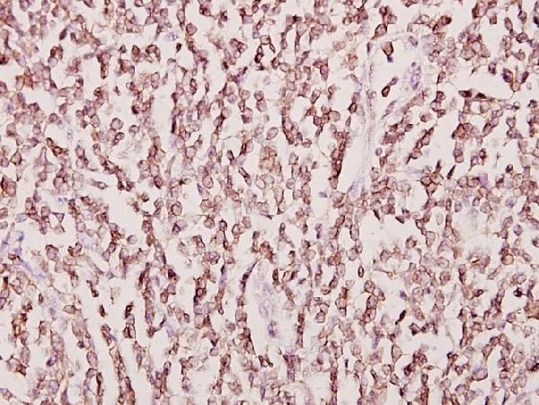 Immunohistochemistry (IHC) analyzes of CKMT2/sMtCK (W262) pAb in paraffin-embedded human tonsil cancer tissue at 1:50