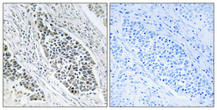 Immunohistochemical analysis of paraffin-embedded Human lung cancer