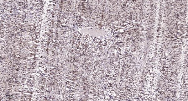 Immunohistochemical analysis of paraffin-embedded human Colon cancer