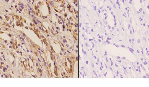 Immunohistochemistry (IHC) analyzes of NXF3 (N104) pAb in paraffin-embedded human kidney carcinoma tissue at 1:50