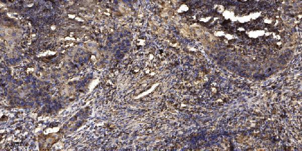 Immunohistochemical analysis of paraffin-embedded human Squamous cell carcinoma of lung