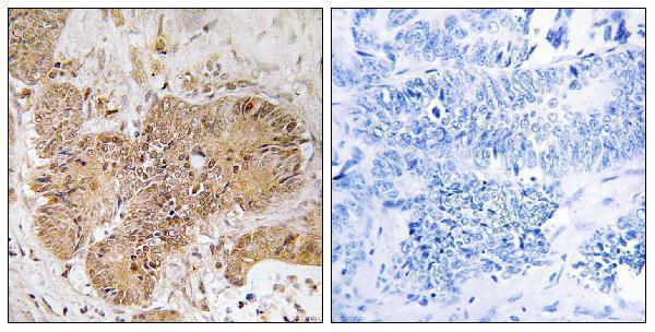 Immunohistochemistry analysis of paraffin-embedded human colon carcinoma tissue, using LUC7L2 Antibody
