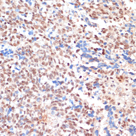 Immunohistochemistry of paraffin-embedded human oophoroma using NAA20 antibody  at dilution of 1:100 