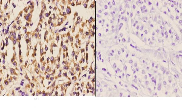 Immunohistochemistry (IHC) analyzes of DGK-ι (K1023) pAb in paraffin-embedded human liver carcinoma tissue at 1:50