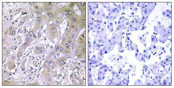 Immunohistochemistry analysis of paraffin-embedded human liver carcinoma tissue, using ACOT12 Antibody