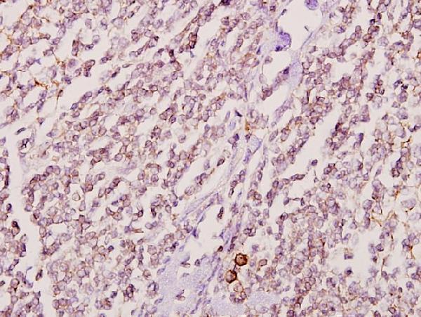 Immunohistochemistry (IHC) analyzes of GK2 (Y306) pAb in paraffin-embedded human tonsil cancer tissue at 1:50