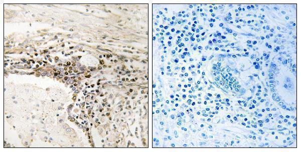 Immunohistochemistryt analysis of paraffin-embedded human lung carcinoma, using SSH3 Antibody