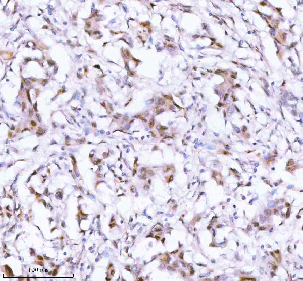 Figure 2. IHC analysis of SSH3 using anti-SSH3 antibody (A11609-3). SSH3 was detected in a paraffin-embedded section of human breast cancer tissue. Heat mediated antigen retrieval was performed in EDTA buffer (pH 8.0, epitope retrieval solution). The tissue section was blocked with 10% goat serum. The tissue section was then incubated with 2 microg/ml rabbit anti-SSH3 Antibody (A11609-3) overnight at 4°C. Peroxidase Conjugated Goat Anti-rabbit IgG was used as secondary antibody and incubated for 30 minutes at 37°C. The tissue section was developed using HRP Conjugated Rabbit IgG Super Vision Assay Kit (Catalog # SV0002) with DAB as the chromogen. Figure 2. IHC analysis of SSH3 using anti-SSH3 antibody (A11609-3). SSH3 was detected in a paraffin-embedded section of human breast cancer tissue. Heat mediated antigen retrieval was performed in EDTA buffer (pH 8.0, epitope retrieval solution). The tissue section was blocked with 10% goat serum. The tissue section was then incubated with 2 microg/ml rabbit anti-SSH3 Antibody (A11609-3) overnight at 4°C. Peroxidase Conjugated Goat Anti-rabbit IgG was used as secondary antibody and incubated for 30 minutes at 37°C. The tissue section was developed using HRP Conjugated Rabbit IgG Super Vision Assay Kit (Catalog # SV0002) with DAB as the chromogen.