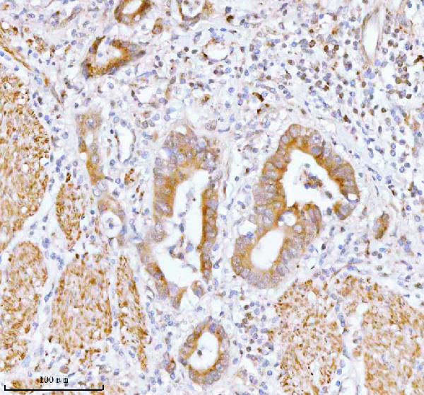 Figure 3. IHC analysis of SSH3 using anti-SSH3 antibody (A11609-3). SSH3 was detected in a paraffin-embedded section of human rectum adenocarcinoma tissue. Heat mediated antigen retrieval was performed in EDTA buffer (pH 8.0, epitope retrieval solution). The tissue section was blocked with 10% goat serum. The tissue section was then incubated with 2 microg/ml rabbit anti-SSH3 Antibody (A11609-3) overnight at 4°C. Peroxidase Conjugated Goat Anti-rabbit IgG was used as secondary antibody and incubated for 30 minutes at 37°C. The tissue section was developed using HRP Conjugated Rabbit IgG Super Vision Assay Kit (Catalog # SV0002) with DAB as the chromogen. Figure 3. IHC analysis of SSH3 using anti-SSH3 antibody (A11609-3). SSH3 was detected in a paraffin-embedded section of human rectum adenocarcinoma tissue. Heat mediated antigen retrieval was performed in EDTA buffer (pH 8.0, epitope retrieval solution). The tissue section was blocked with 10% goat serum. The tissue section was then incubated with 2 microg/ml rabbit anti-SSH3 Antibody (A11609-3) overnight at 4°C. Peroxidase Conjugated Goat Anti-rabbit IgG was used as secondary antibody and incubated for 30 minutes at 37°C. The tissue section was developed using HRP Conjugated Rabbit IgG Super Vision Assay Kit (Catalog # SV0002) with DAB as the chromogen.